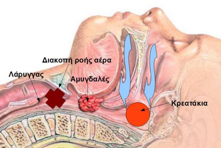Τα μεγάλα κρεατάκια (υπερτροφία αδενοειδών). Τα προβλήματα στην διάγνωση κ θεραπεία